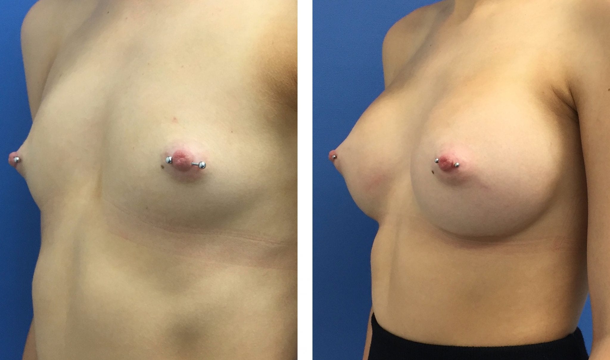 L anterior oblique