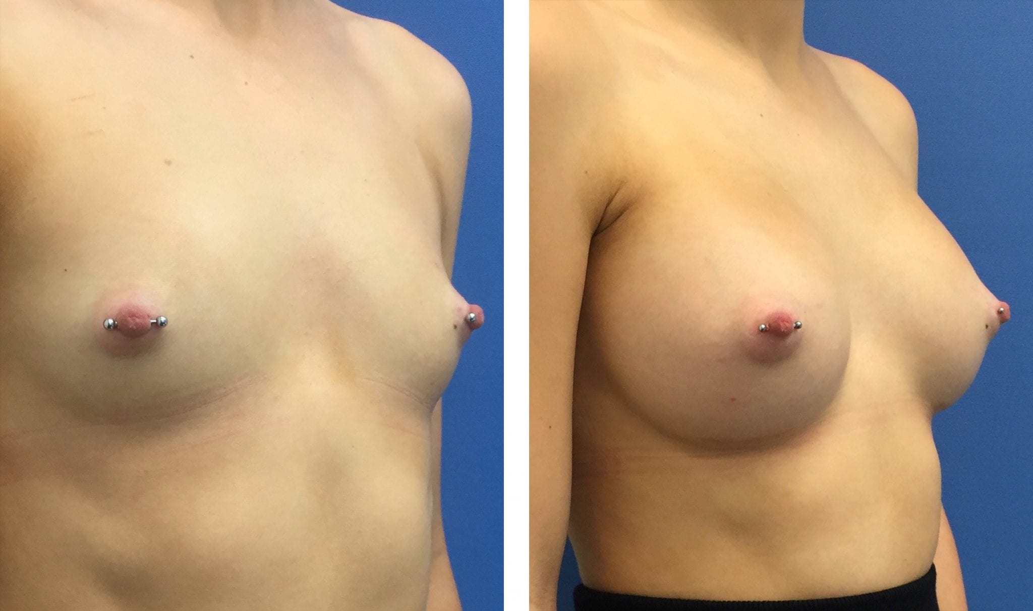 R anterior oblique